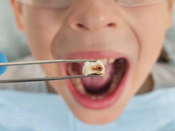 Best Urgent Care for Lost Fillings or Crowns in New Market, TN